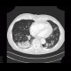 Panlobular emphysema, vanishing lung syndrome, bullous emphysema: CT - Computed tomography